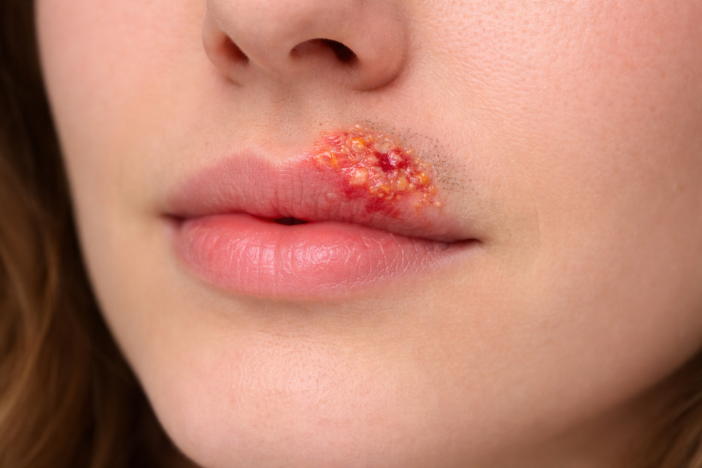 Herpes labial: o que é, sintomas, causas, transmissão, diagnóstico, tratamento e prevenção