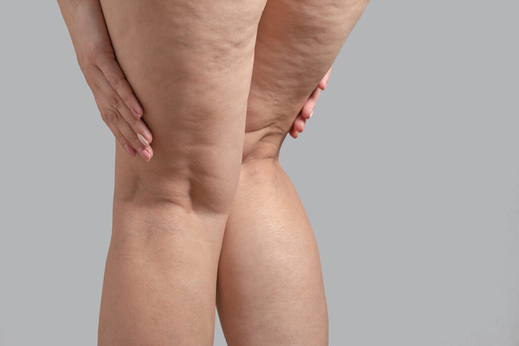 Tratamento para Lipedema