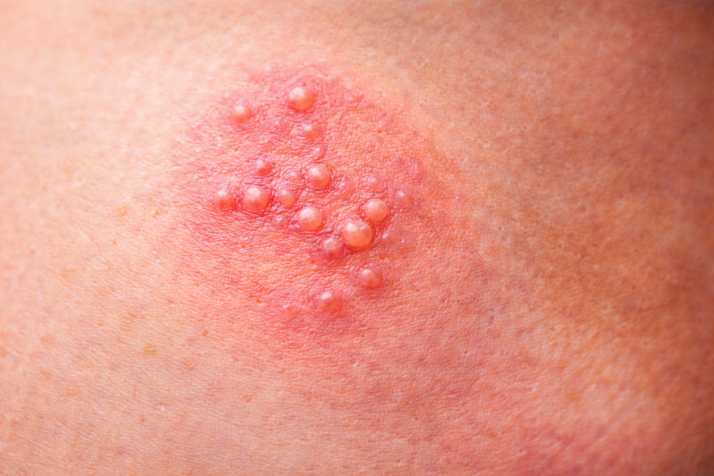 Tratamento para herpes genital: remédios, pomadas e cuidados essenciais