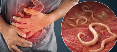 Vermes Intestinais