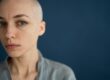alopecia alopecia