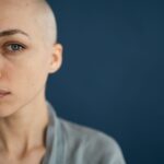 alopecia alopecia