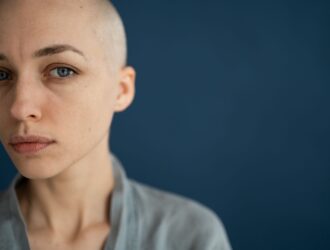 alopecia alopecia