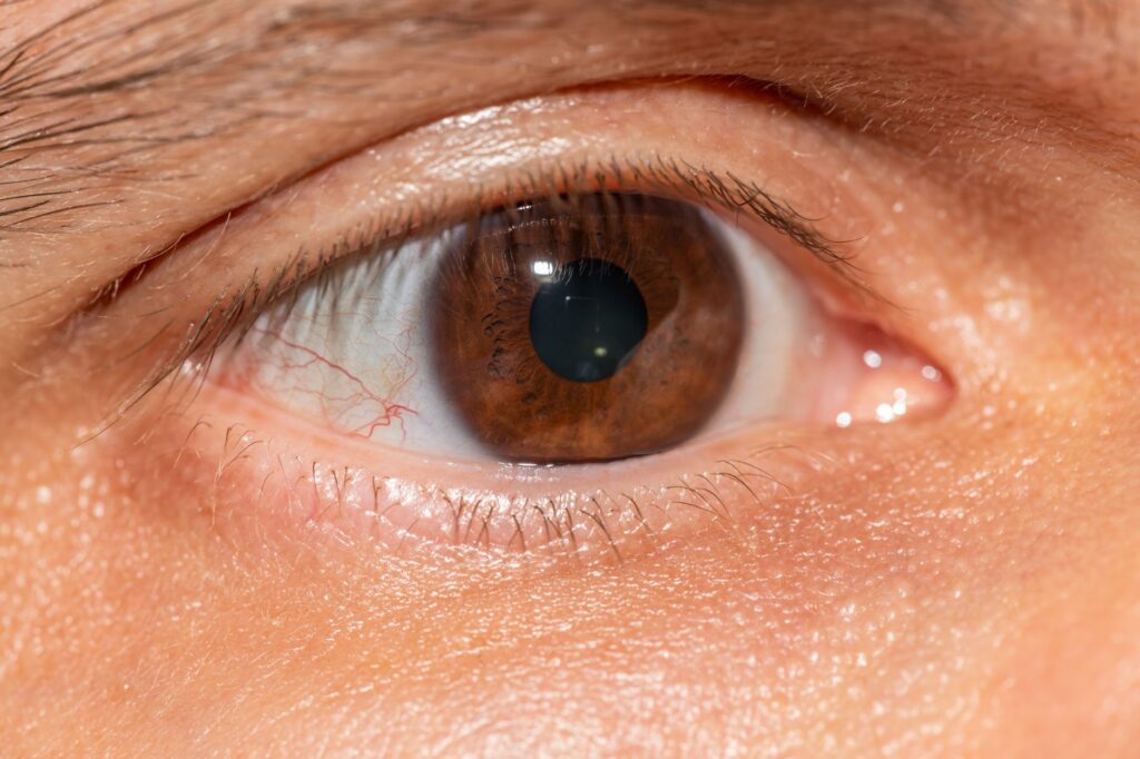 Glaucoma: Entenda o que é, causas, sintomas e tratamentos