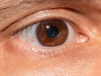 glaucoma glaucoma