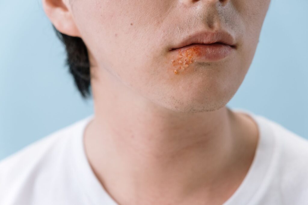 Tudo Sobre Herpes: Causas, Sintomas e Tratamentos