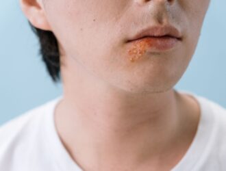 herpes herpes