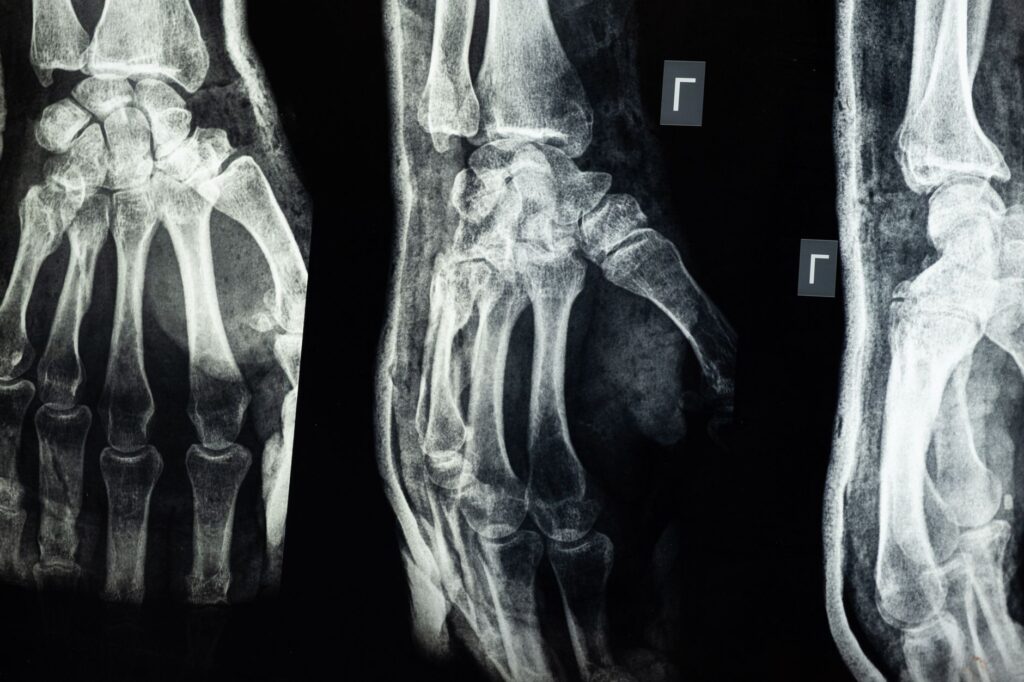 Osteoporose: Causas, Sintomas e Tratamentos Eficazes