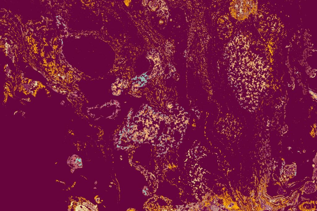 Pancreatite: Causas, Sintomas e Tratamentos Eficazes
