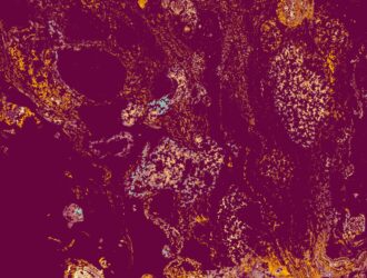 pancreatite pancreatite