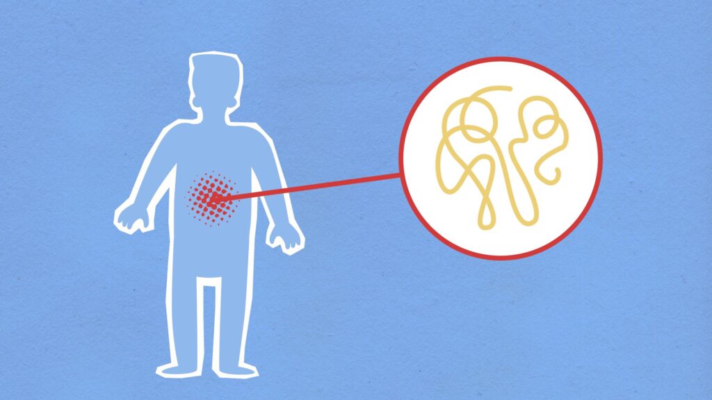 H. Pylori: Causas, Sintomas e Tratamentos Eficazes
