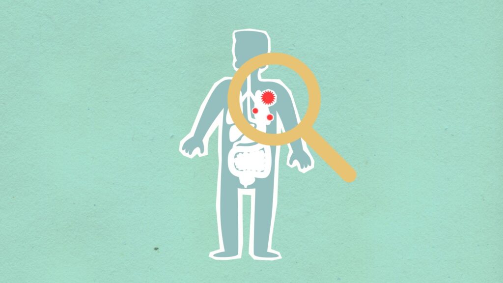 Tuberculose: Causas, Sintomas e Tratamentos Eficazes