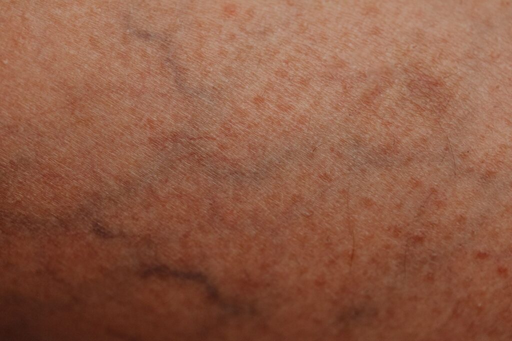 Varizes: Causas, Sintomas, Tratamentos e Prevenção