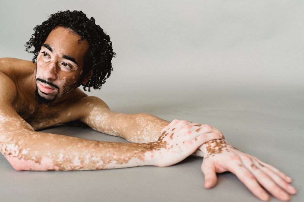 Vitiligo: Causas, Sintomas e Tratamentos Eficazes