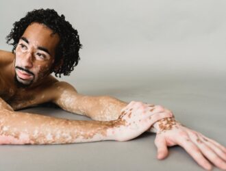 vitiligo vitiligo
