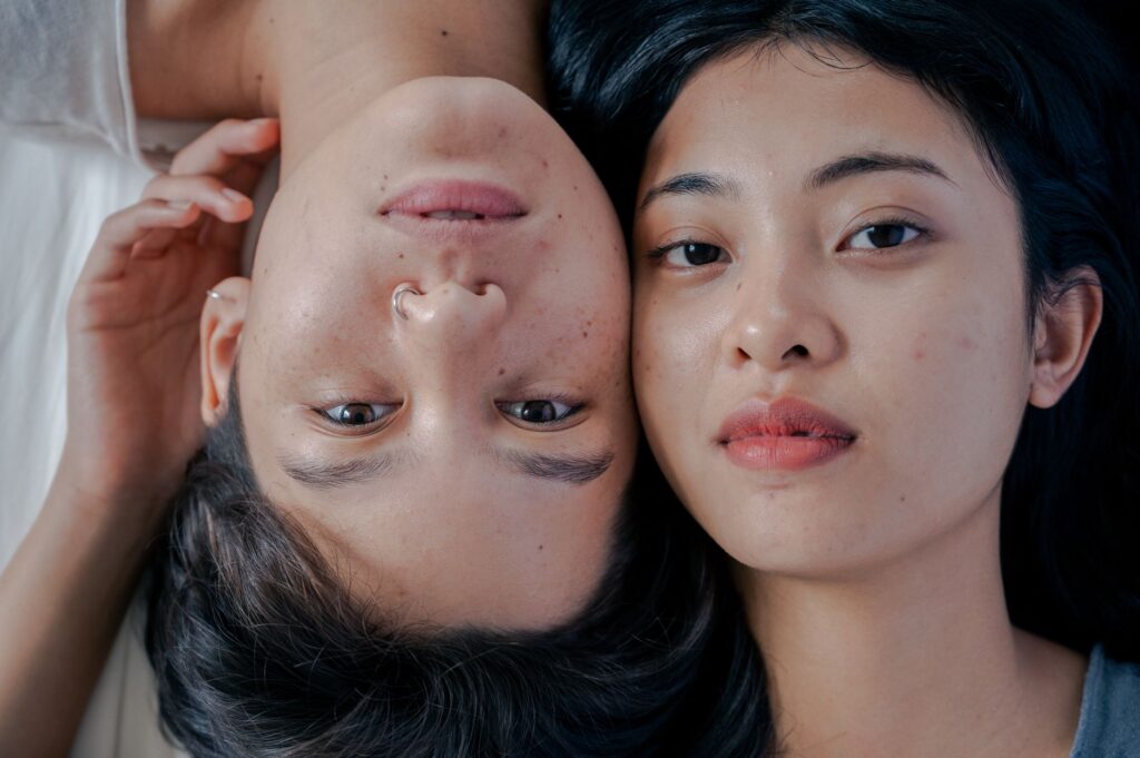 Epiduo: O Guia Completo para Tratamento da Acne